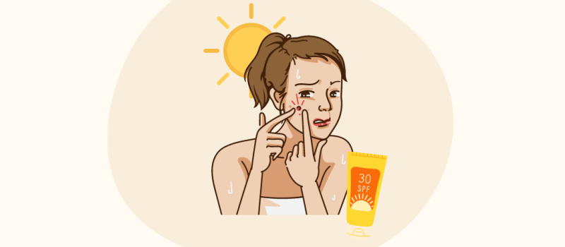 Zon en acne: Vriend of vijand?